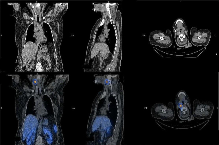 Incidental Synchronous <sup>99m</sup>Tc-HYNIC-TOC Avid Lesion of the Neck in a Patient with Metastatic Melanoma: A Metastatic Lymph Node or a Carotid Body Tumor Masquerading As a Lymph Node?