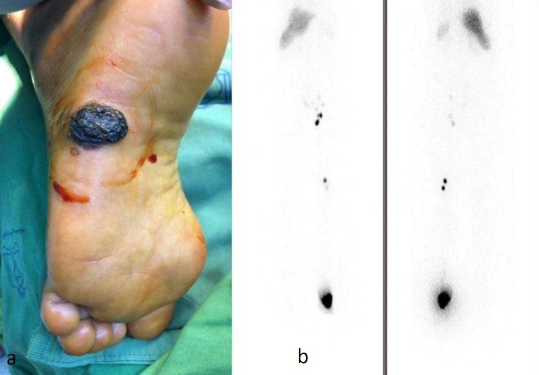 Incidental Synchronous <sup>99m</sup>Tc-HYNIC-TOC Avid Lesion of the Neck in a Patient with Metastatic Melanoma: A Metastatic Lymph Node or a Carotid Body Tumor Masquerading As a Lymph Node?