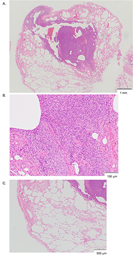 A case of secondary pneumothorax due to multiple pulmonary metastases of granulosa cell tumor.