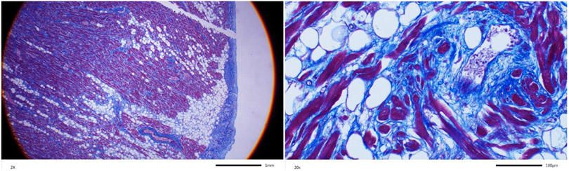 Oligogenic cardiomyopathy.