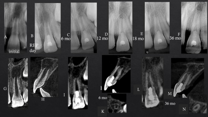 Regenerative Endodontic Treatment of a Traumatized Immature Necrotic Permanent Incisor: A Case Report.