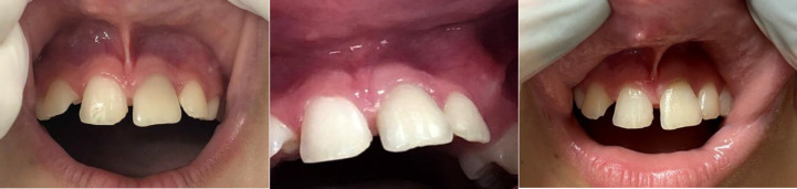 Regenerative Endodontic Treatment of a Traumatized Immature Necrotic Permanent Incisor: A Case Report.