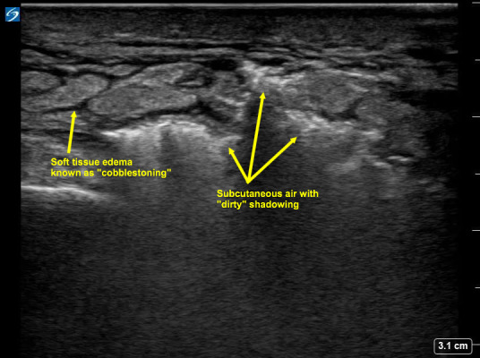 Sonographic Crepitus, a Point-of-Care Ultrasound Finding.