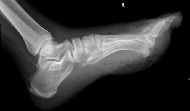 Sonographic Crepitus, a Point-of-Care Ultrasound Finding.