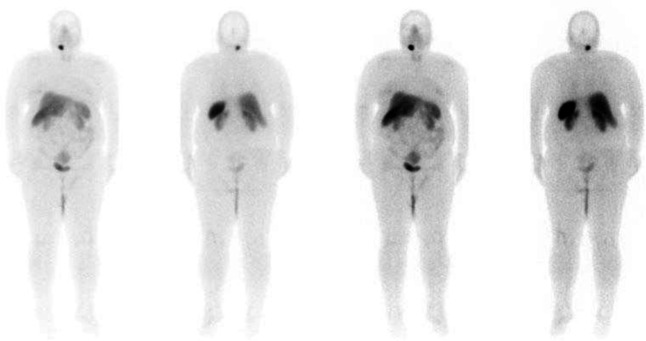 Incidental Synchronous <sup>99m</sup>Tc-HYNIC-TOC Avid Lesion of the Neck in a Patient with Metastatic Melanoma: A Metastatic Lymph Node or a Carotid Body Tumor Masquerading As a Lymph Node?