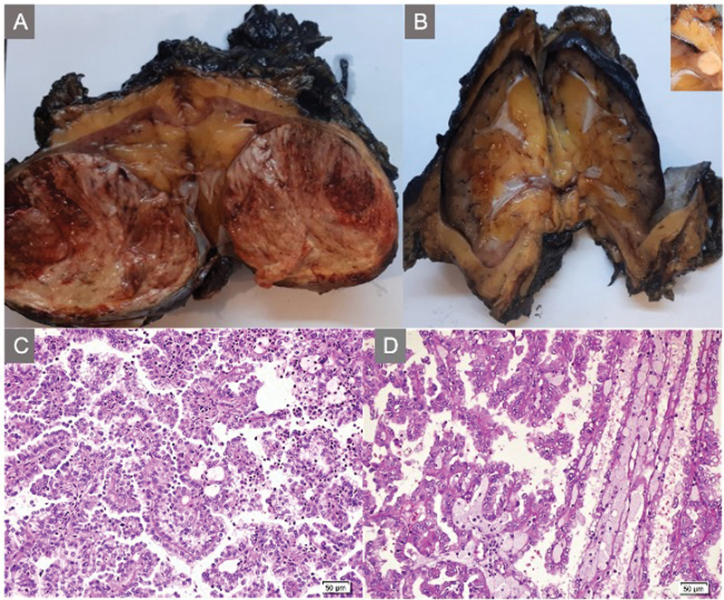 Bilateral Native Kidney Papillary Renal Cell Carcinomas in a 11-Year-Old Renal Transplant Patient.