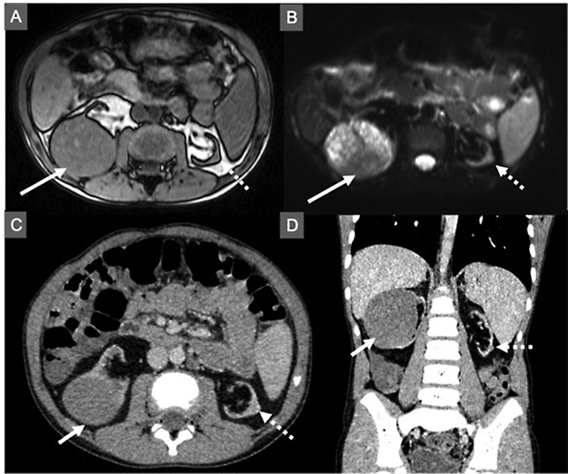 Bilateral Native Kidney Papillary Renal Cell Carcinomas in a 11-Year-Old Renal Transplant Patient.