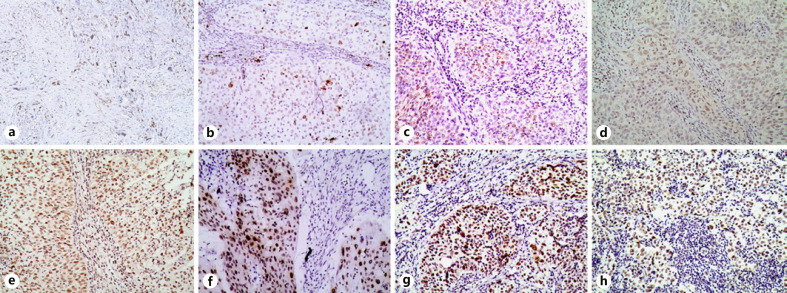 Relationship between Human Papillomavirus Prevalence and DNA Damage in Cervical Cancer Population in Gansu Province, China.