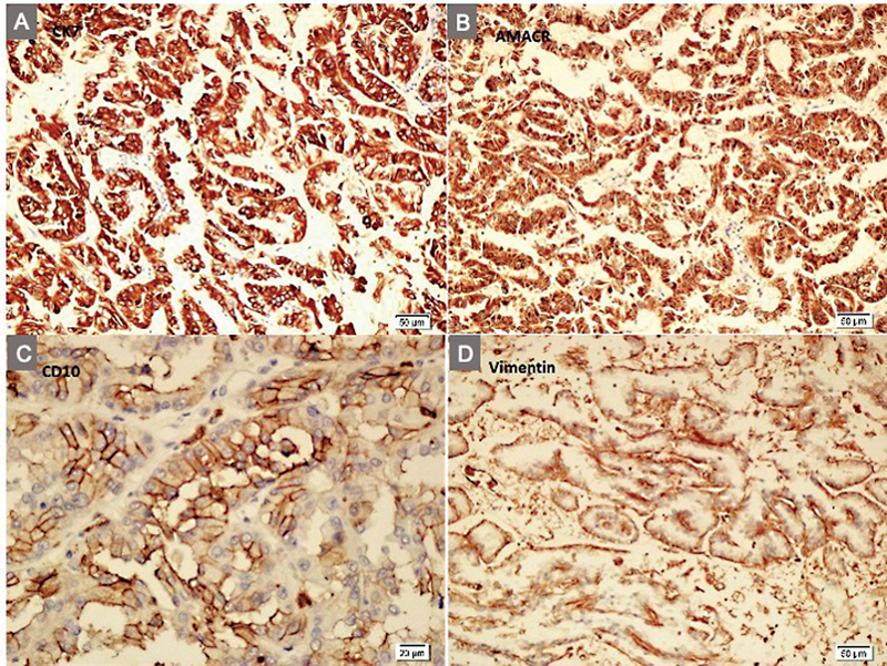 Bilateral Native Kidney Papillary Renal Cell Carcinomas in a 11-Year-Old Renal Transplant Patient.