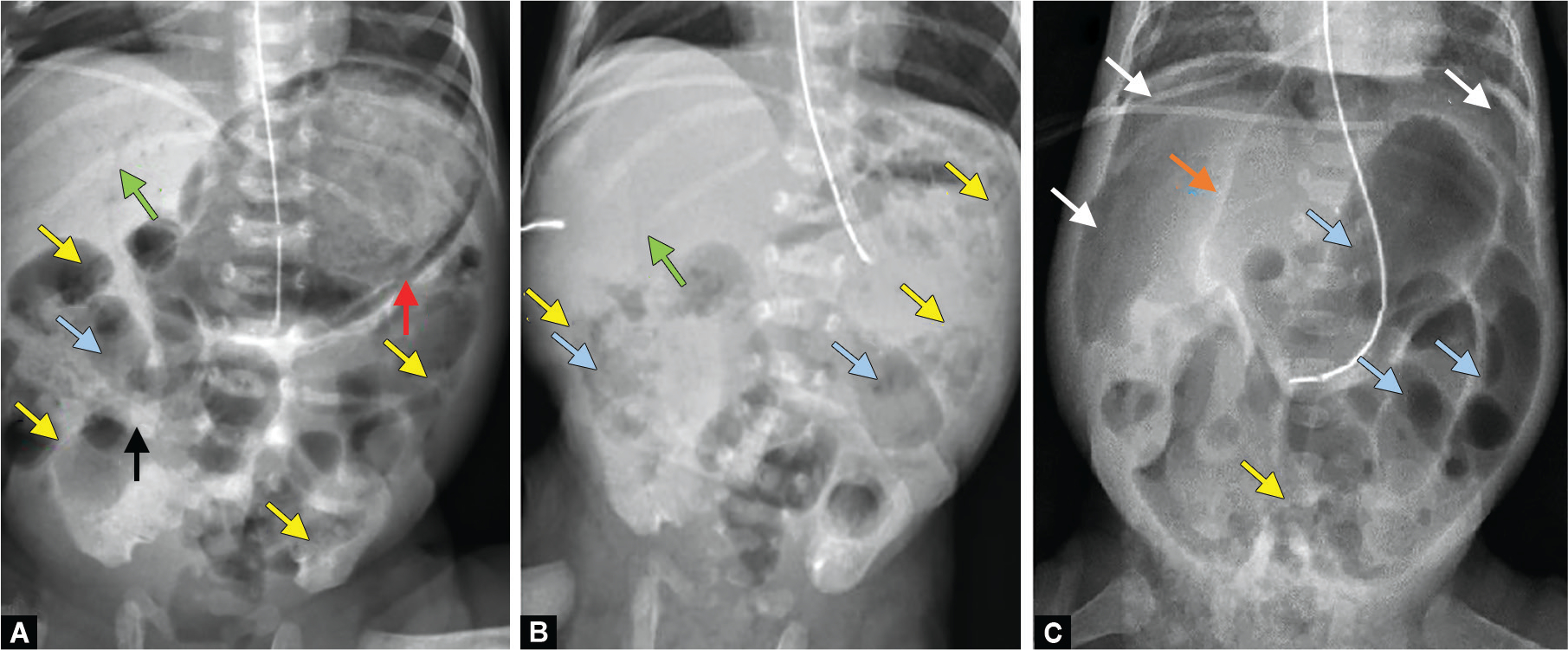 Imaging for Diagnosis and Assessment of Necrotizing Enterocolitis.