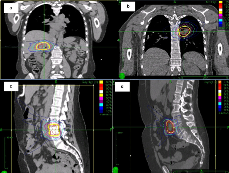 Treatment outcomes of stereotactic ablative body radiotherapy on oligometastases from colorectal cancer: early results of a single institution service evaluation.