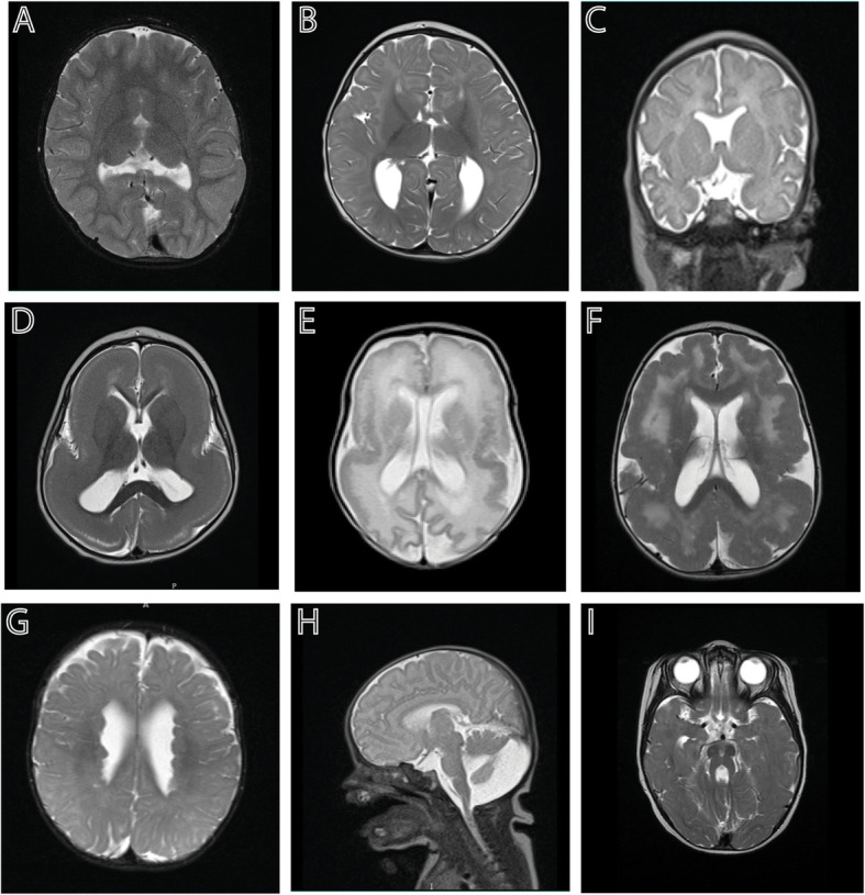 CNS Malformations in the Newborn.