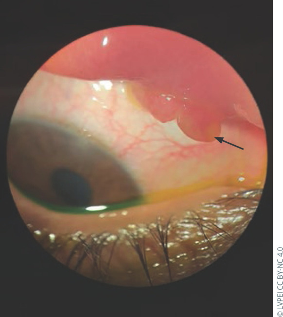 Conjunctival pyogenic granuloma following insect bite.