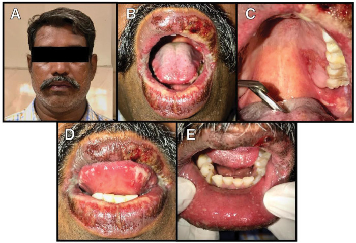 Drug induced erythema multiforme of the oral cavity.