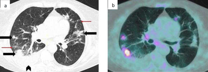 <sup>18</sup>F-FDG PET-CT incidental lung findings in asymptomatic COVID-19 patients: evidences from the Italian core of the first pandemic peak.