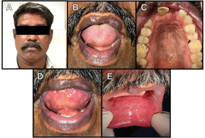 Drug induced erythema multiforme of the oral cavity.