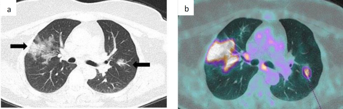 <sup>18</sup>F-FDG PET-CT incidental lung findings in asymptomatic COVID-19 patients: evidences from the Italian core of the first pandemic peak.