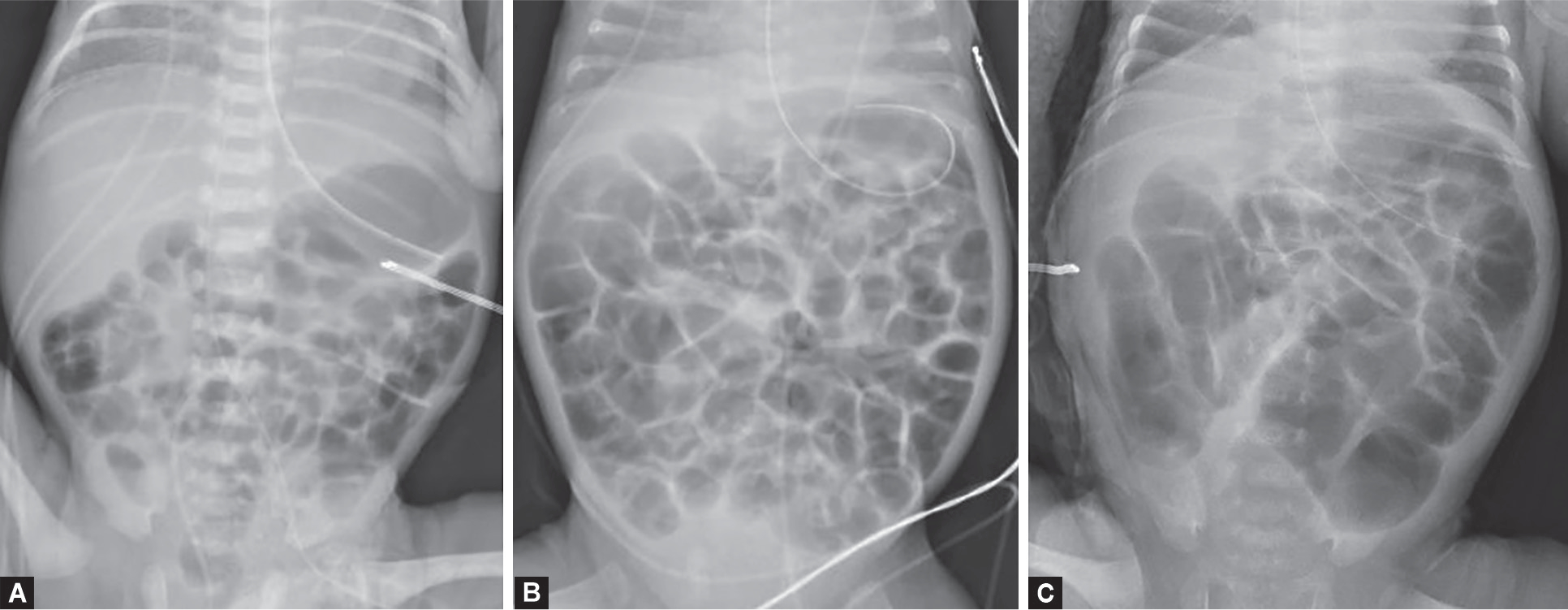 Imaging for Diagnosis and Assessment of Necrotizing Enterocolitis.