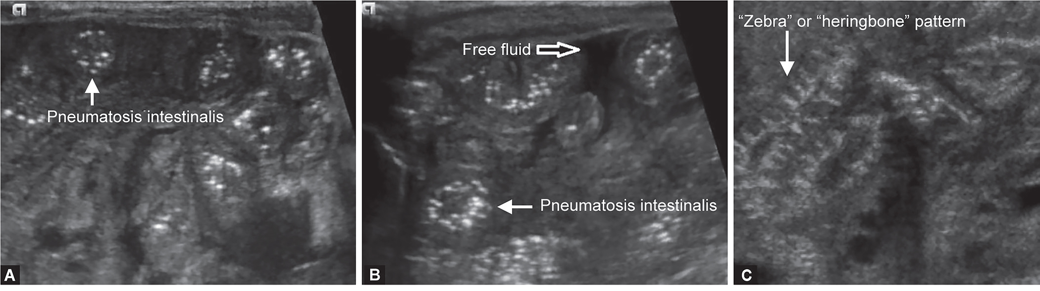 Imaging for Diagnosis and Assessment of Necrotizing Enterocolitis.