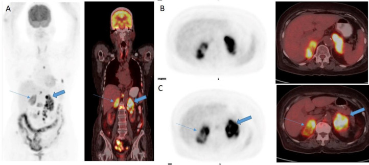 Metastatic bilateral adrenal sarcomatoid carcinoma: Evaluation by <sup>18</sup>F-FDG PET/CT.