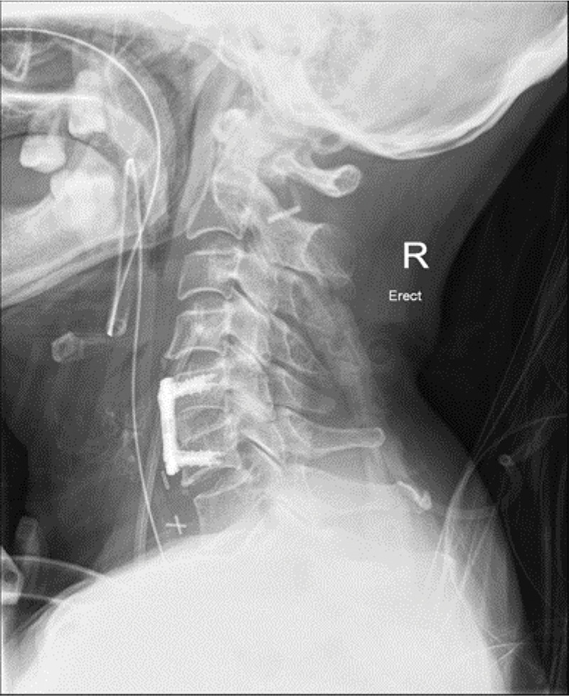 Bilateral recurrent laryngeal nerve palsy following anterior cervical surgery subsequent to contralateral apical lung radiotherapy.