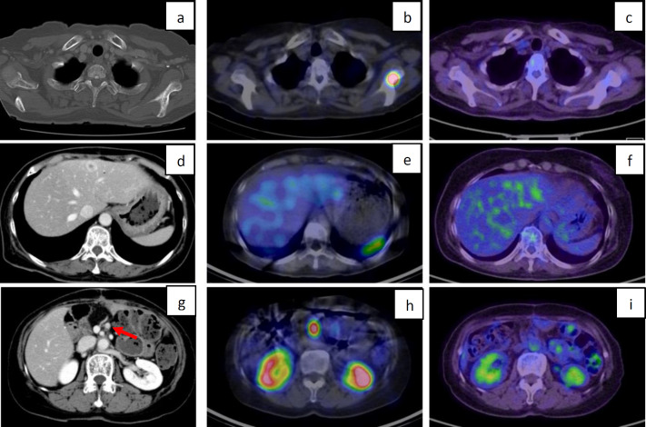 Clinical usefulness of Somatostatin Receptor Scintigraphy in the Diagnosis of Neuroendocrine Neoplasms.