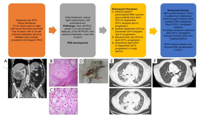 An autologous humanized patient-derived xenograft (PDX) model for evaluation of nivolumab immunotherapy in renal cell cancer: a case report.