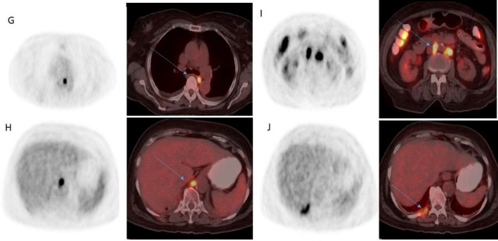 Metastatic bilateral adrenal sarcomatoid carcinoma: Evaluation by <sup>18</sup>F-FDG PET/CT.