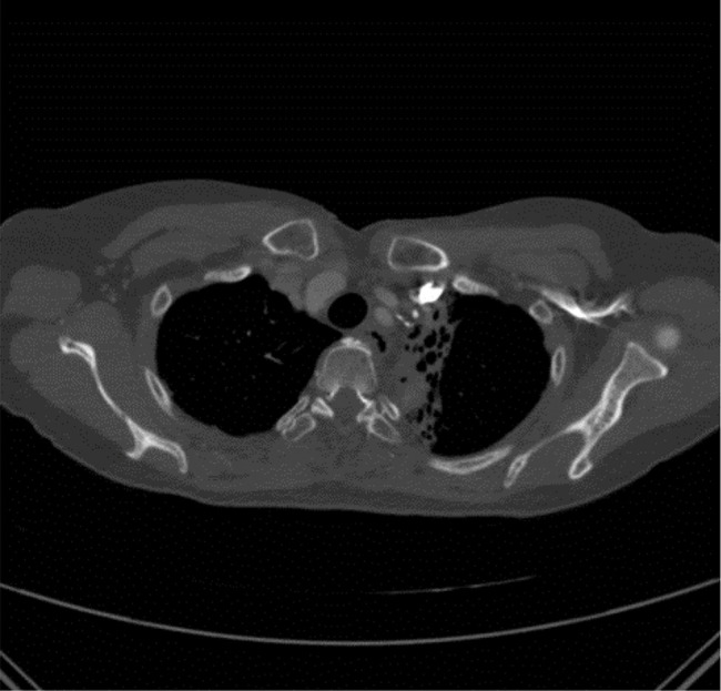 Bilateral recurrent laryngeal nerve palsy following anterior cervical surgery subsequent to contralateral apical lung radiotherapy.