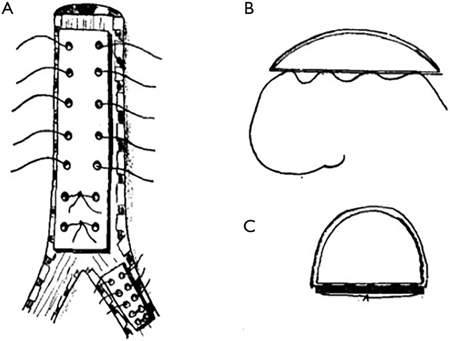 The evolution of tracheobronchoplasty.