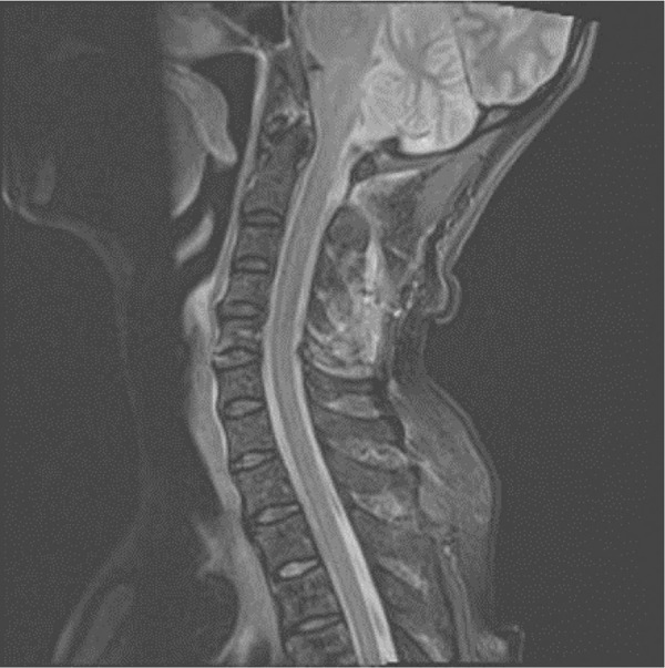 Bilateral recurrent laryngeal nerve palsy following anterior cervical surgery subsequent to contralateral apical lung radiotherapy.