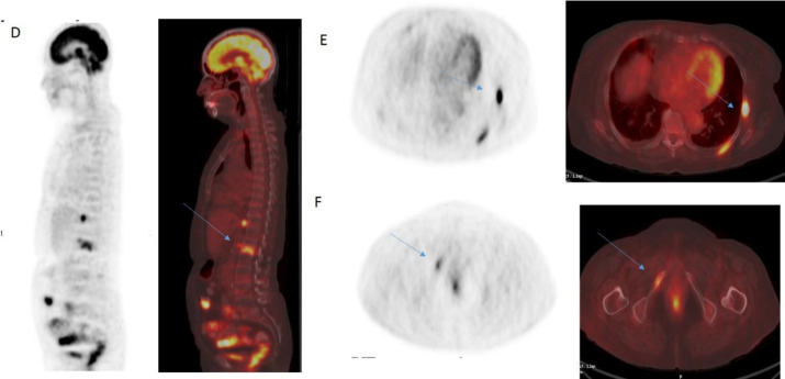 Metastatic bilateral adrenal sarcomatoid carcinoma: Evaluation by <sup>18</sup>F-FDG PET/CT.