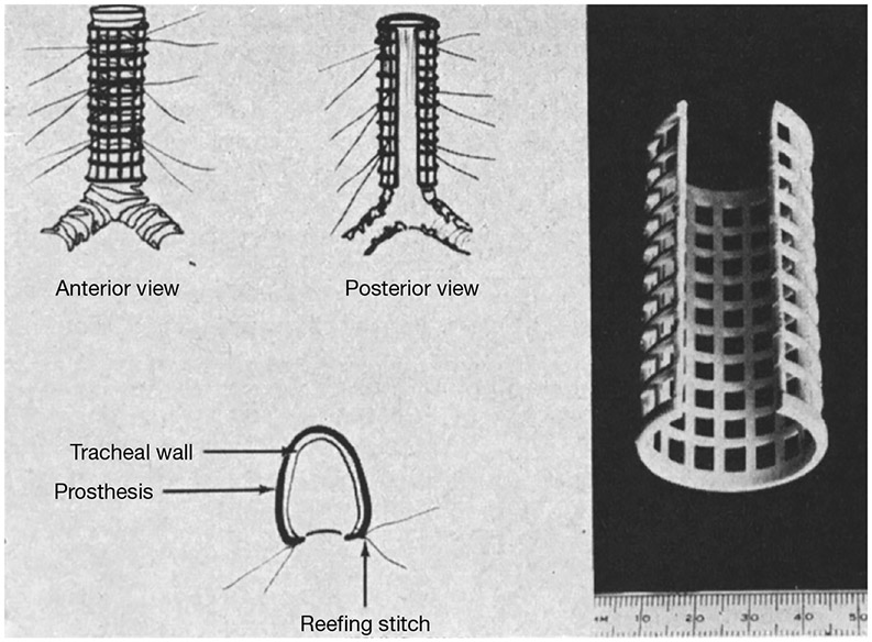 The evolution of tracheobronchoplasty.