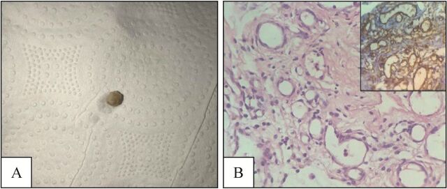 Incidental finding of intra-abdominal hemangioma in an infant presenting with intestinal obstruction: a case report.