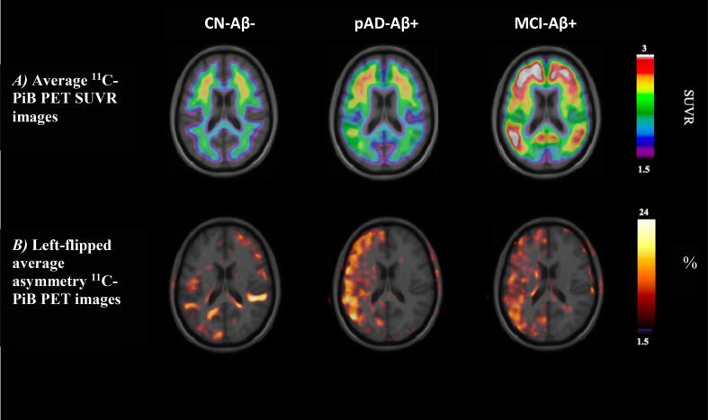 Asymmetric amyloid deposition in preclinical Alzheimer’s disease: A PET study