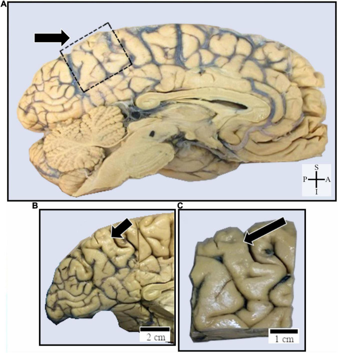 Spindle-Shaped Neurons in the Human Posteromedial (Precuneus) Cortex.