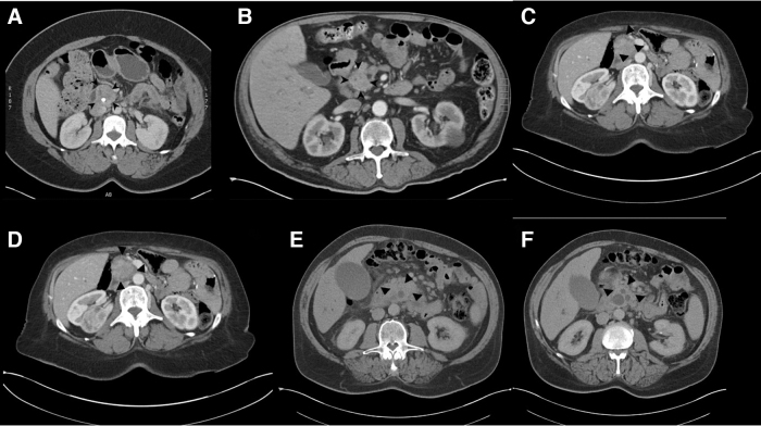 "Infiltrative" Versus "Mass-Forming" Pancreatic Cancer: A New Radiological Classification System for Pancreatic Head Ductal Carcinoma and Its Pathological Correlation.