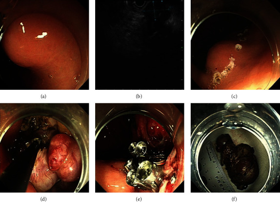 Efficacy and Safety of Endoscopic Resection for Small Gastric Gastrointestinal Stromal Tumors in Elderly Patients.