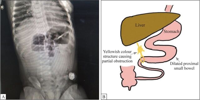 Incidental finding of intra-abdominal hemangioma in an infant presenting with intestinal obstruction: a case report.