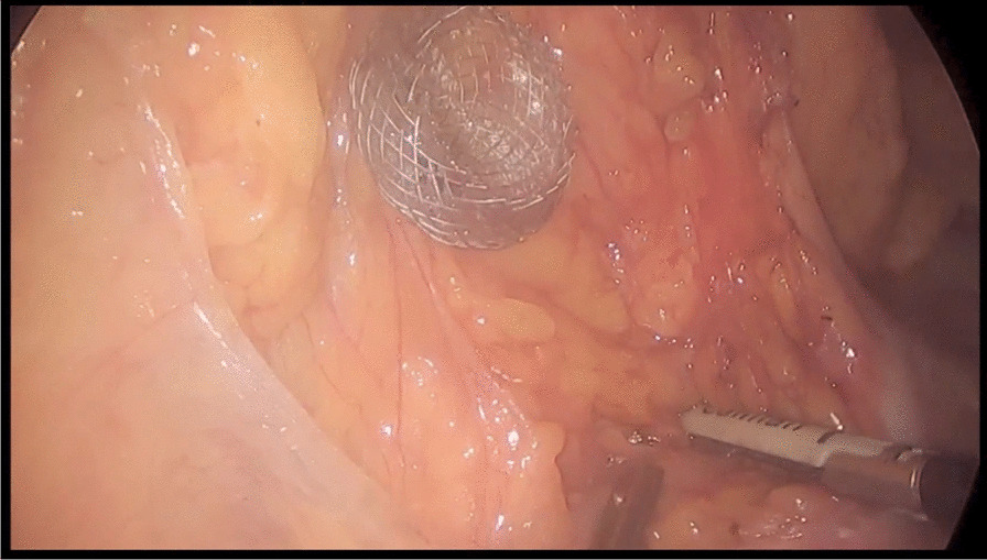 Hybrid gastroenterostomy using a lumen-apposing metal stent: a case report focusing on misdeployment and systematic review of the current literature.