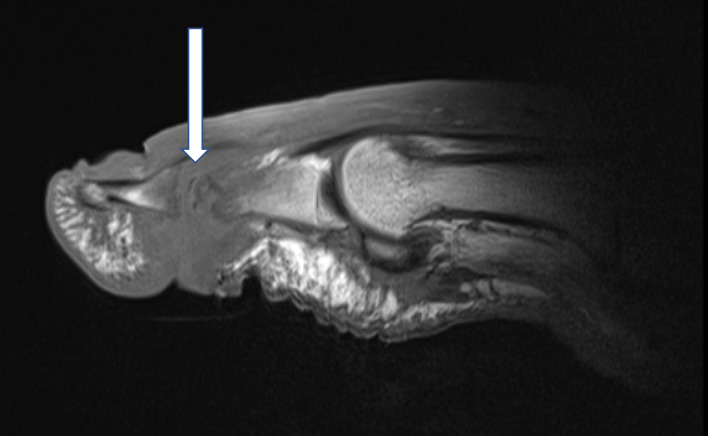 Short and oral antimicrobial therapy for diabetic foot infection: a narrative review of current knowledge.