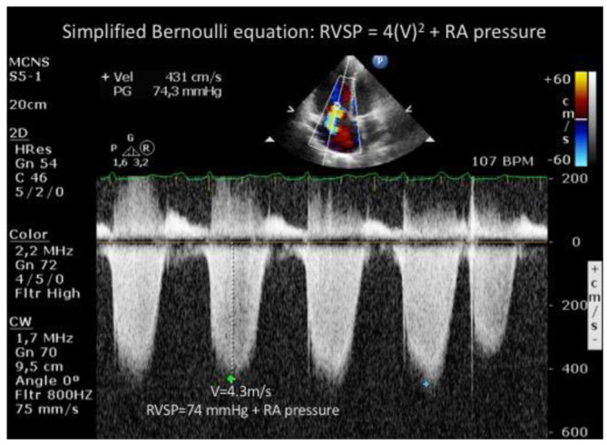 Echocardiographic estimate of pulmonary artery pressure in sarcoidosis patients - real world data from a multi-national study.