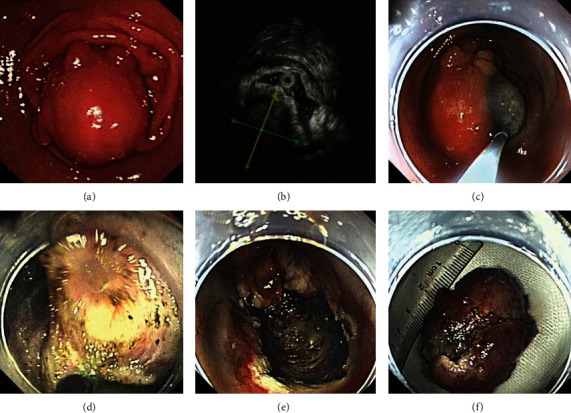 Efficacy and Safety of Endoscopic Resection for Small Gastric Gastrointestinal Stromal Tumors in Elderly Patients.