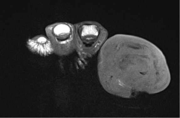 Short and oral antimicrobial therapy for diabetic foot infection: a narrative review of current knowledge.