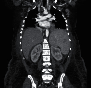 An Unusual Case of Kidney Injury in a Young Woman with a Connective Tissue Disease.