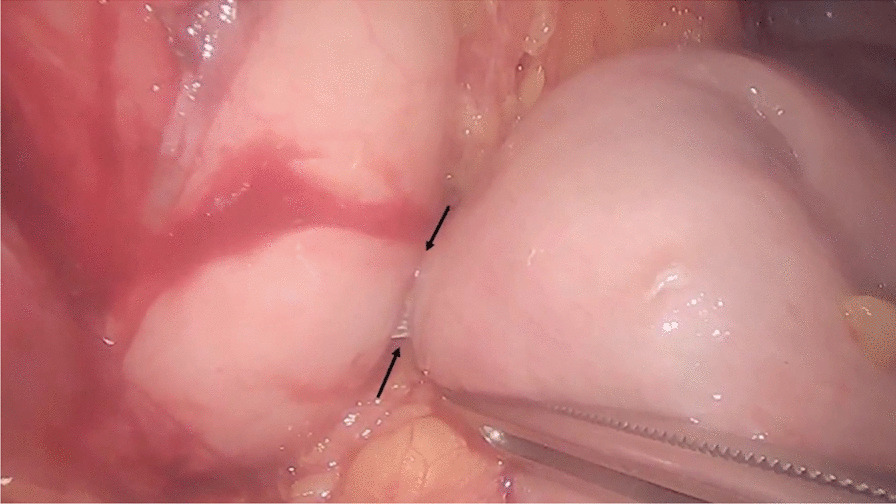 Hybrid gastroenterostomy using a lumen-apposing metal stent: a case report focusing on misdeployment and systematic review of the current literature.