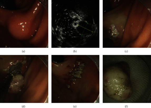 Efficacy and Safety of Endoscopic Resection for Small Gastric Gastrointestinal Stromal Tumors in Elderly Patients.