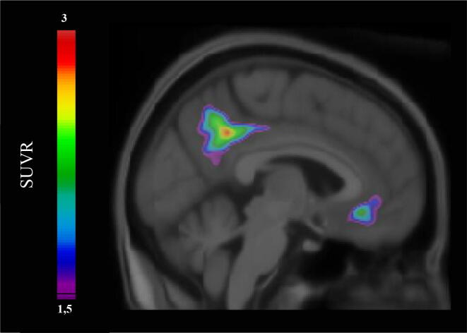 Asymmetric amyloid deposition in preclinical Alzheimer’s disease: A PET study