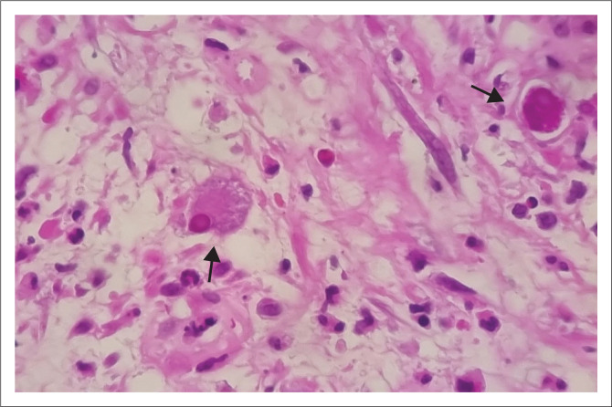 Multisystem cytomegalovirus end-organ disease in a patient with advanced HIV.