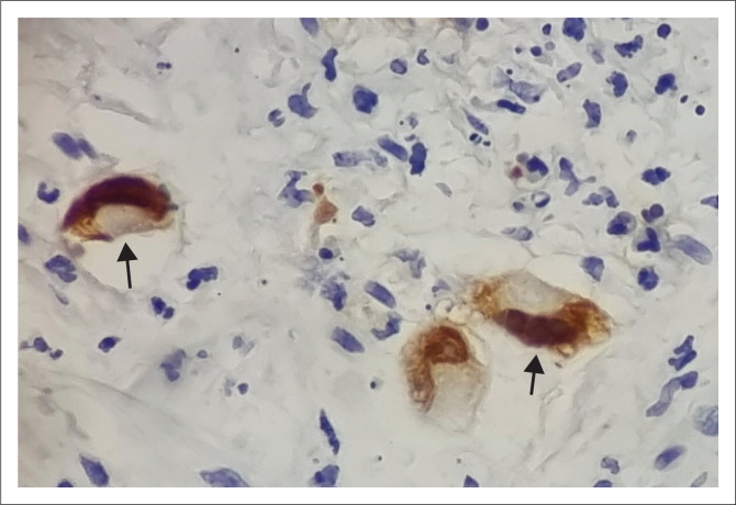 Multisystem cytomegalovirus end-organ disease in a patient with advanced HIV.